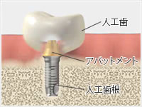 人工歯根　アバットメント