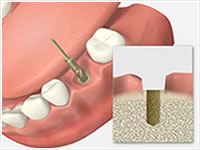 インプラント埋入手術